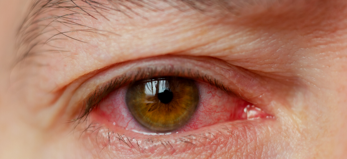 Living with glaucoma | NUHS
