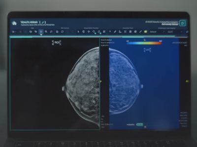How deep tech is revolutionising mammogram screening