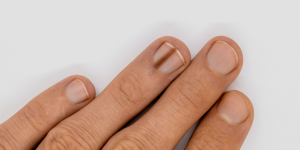 What is nail melanoma and is it a cause for concern?