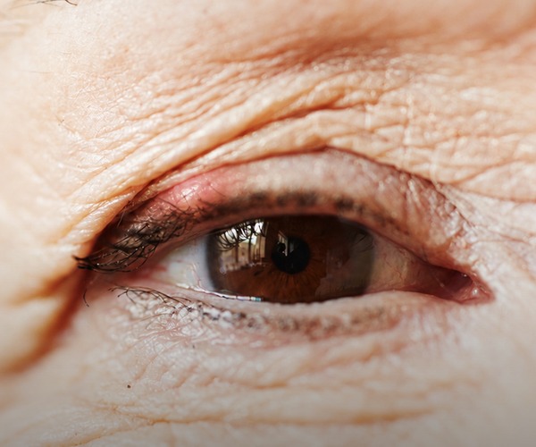 Keep getting styes? Could it be more than bad luck?