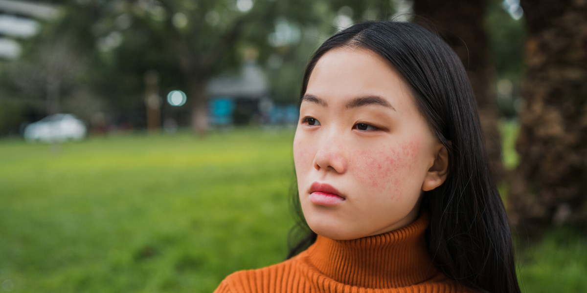 Redness on the face: How to treat rosacea
