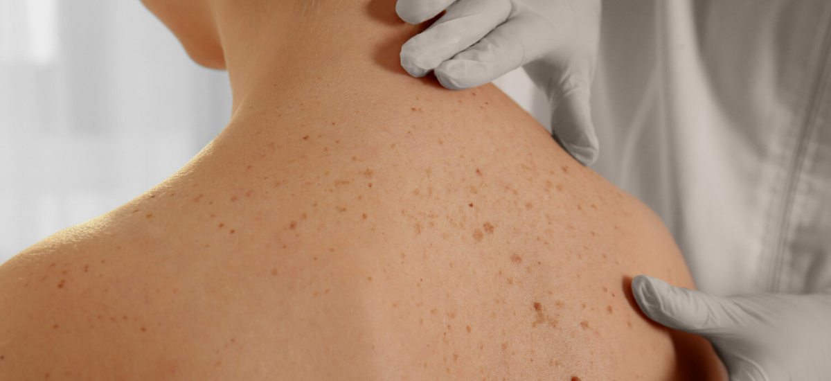 Are your moles changing in size, shape and colour?