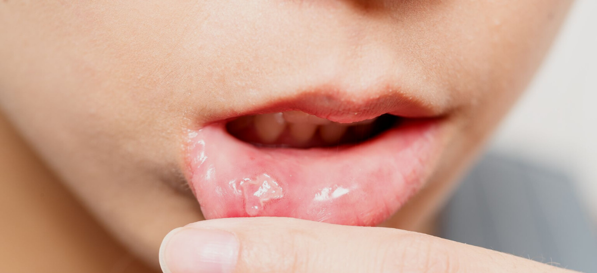 When are oral ulcers a cause for worry?