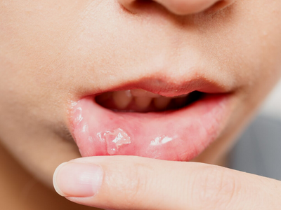 When are oral ulcers a cause for worry?