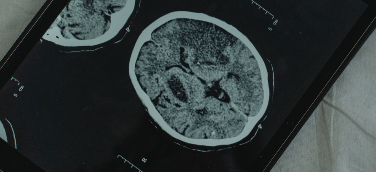 Younger adults facing stroke risk, doctors warn