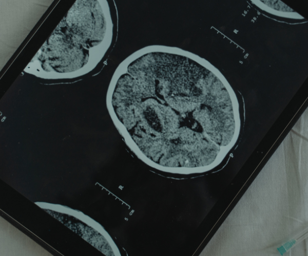 Younger adults facing stroke risk, doctors warn