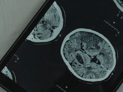 Younger adults facing stroke risk, doctors warn